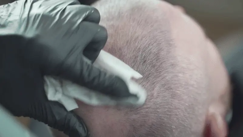 Clinician preparing a patient's scalp before treatment