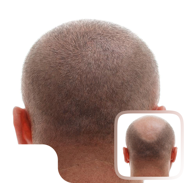 Crown hair transplant before and after result